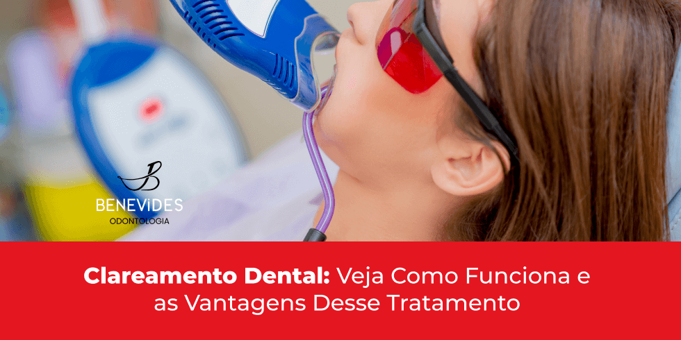 Clareamento Dental: Veja Como Funciona e as Vantagens Desse Tratamento