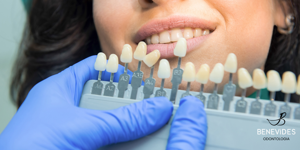 Clareamento Dental: Veja Como Funciona e as Vantagens Desse Tratamento 