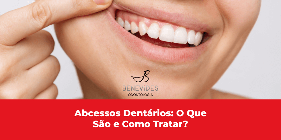 Abcessos Dentários: O Que São e Como Tratar?