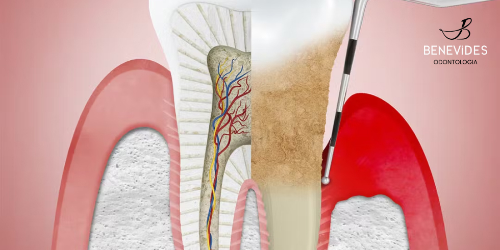 Periodontite: Entenda o Que é Essa Condição e Como Tratá-la