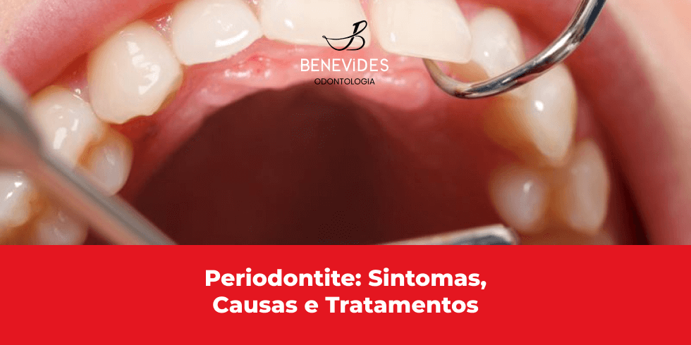 Periodontite: Entenda o Que é Essa Condição e Como Tratá-la