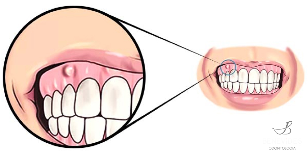 Abcessos Dentários: O Que São e Como Tratar?